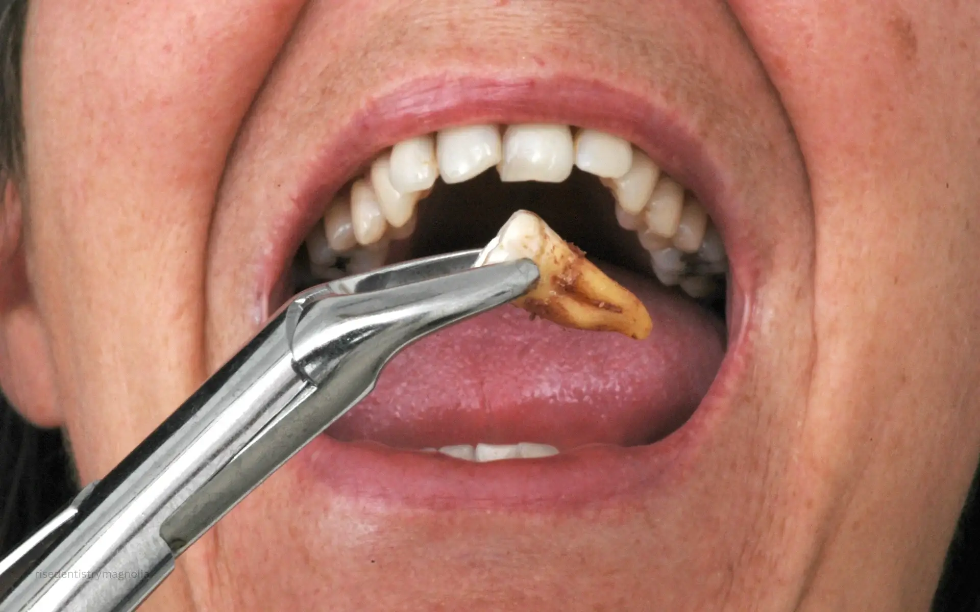 how much is a tooth extraction