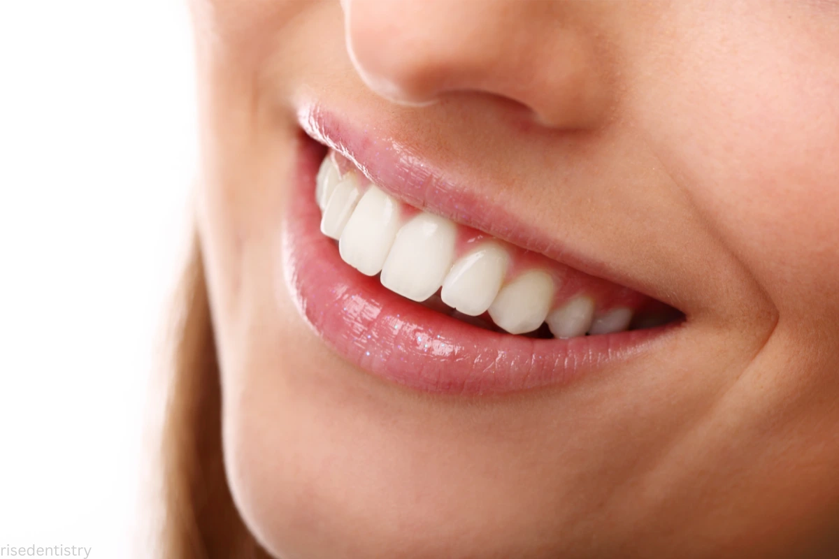 average cost of teeth whitening