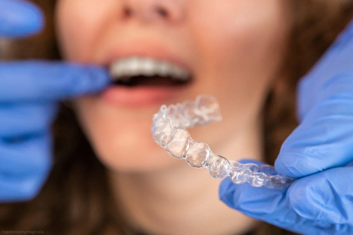 benefits of choosing non brace teeth alignment