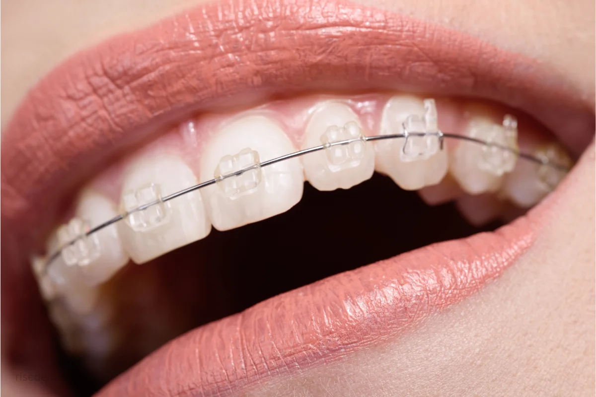 best teeth straightening aligners