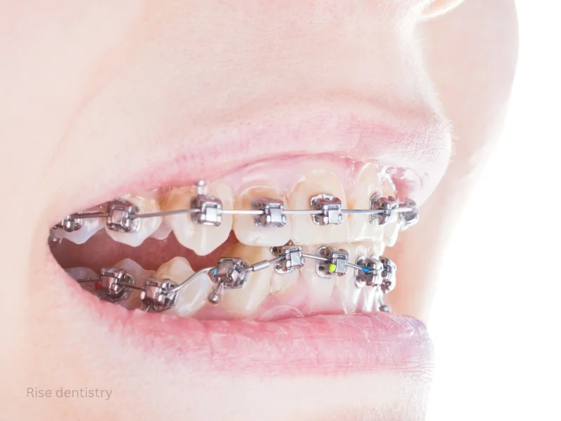 best way to straighten teeth for adults