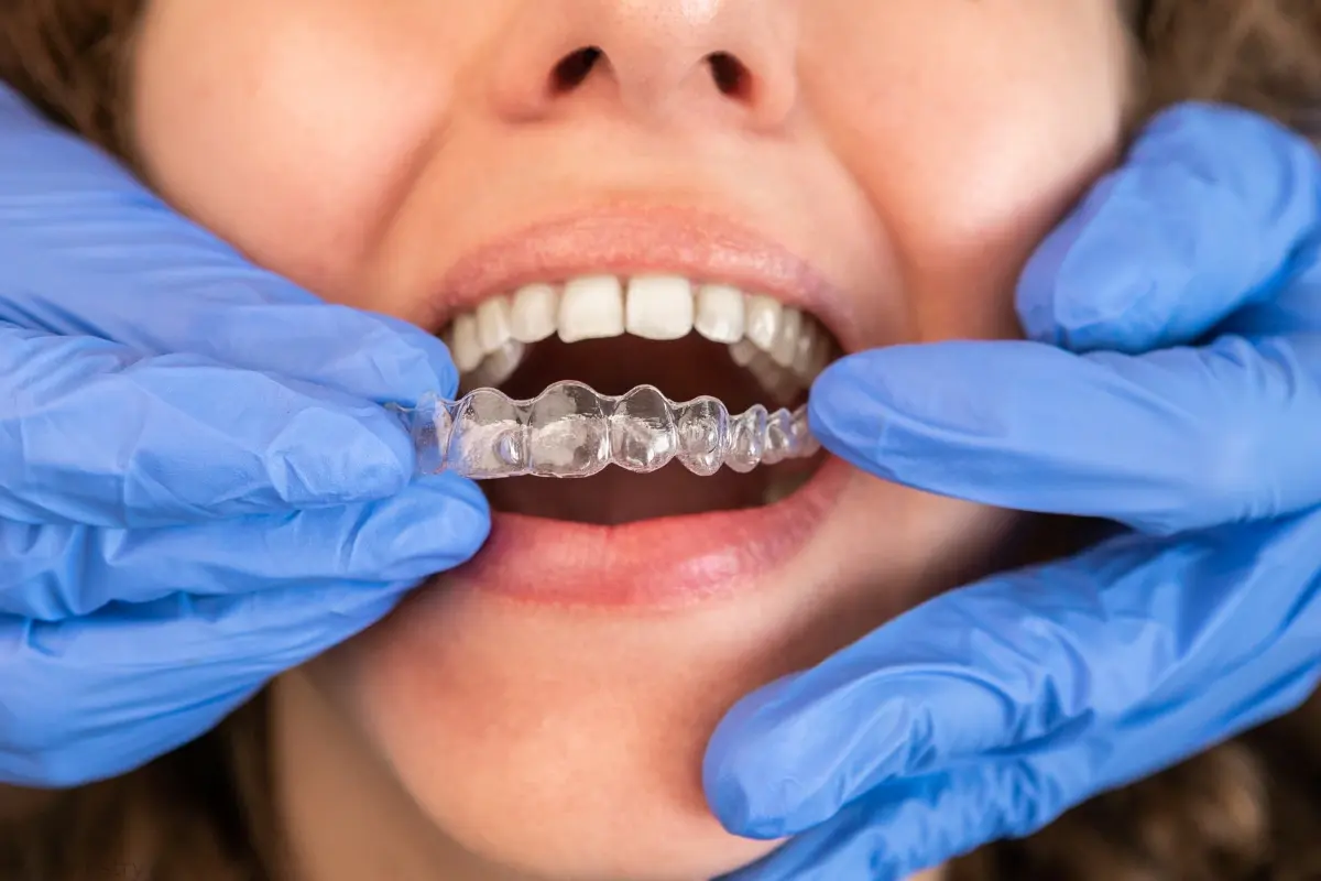 braces vs clear aligners efficiency