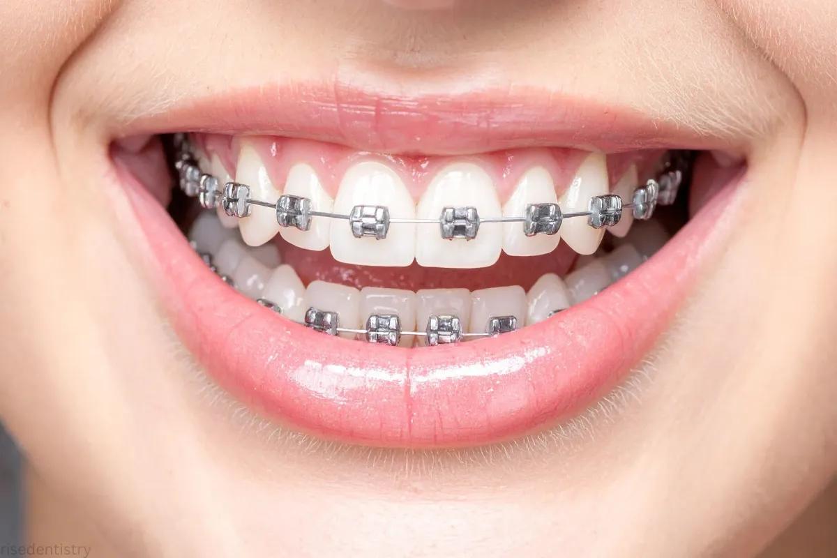 braces vs clear aligners