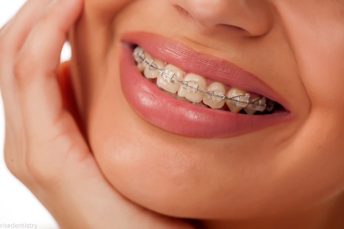 clear braces vs aligners as adults