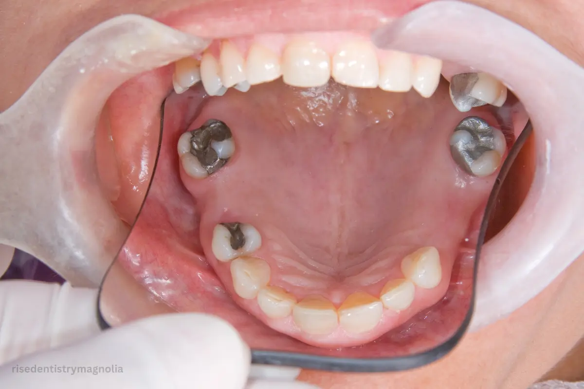 cost of tooth implant vs root canal