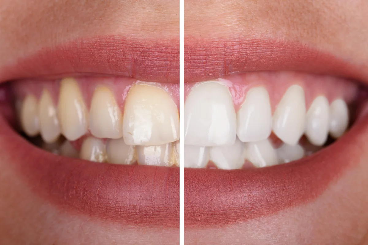 dental bonding cost