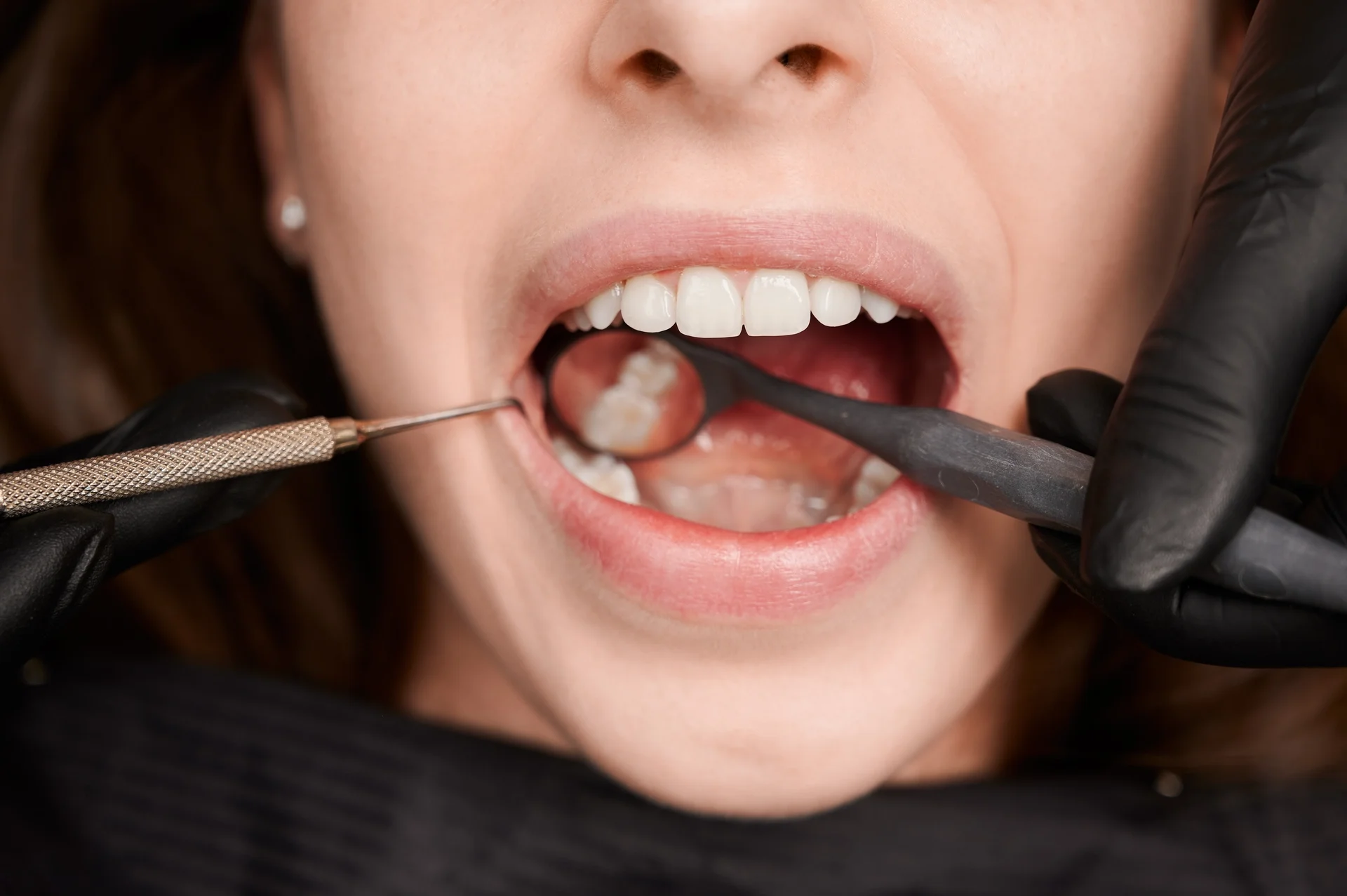 dental bonding in magnolia tx