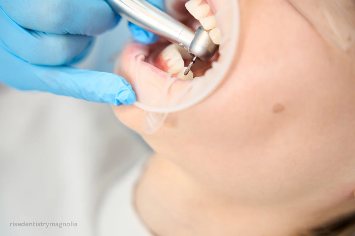 filling or root canal