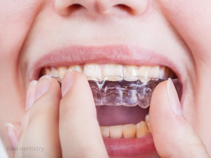 fixing an open bite