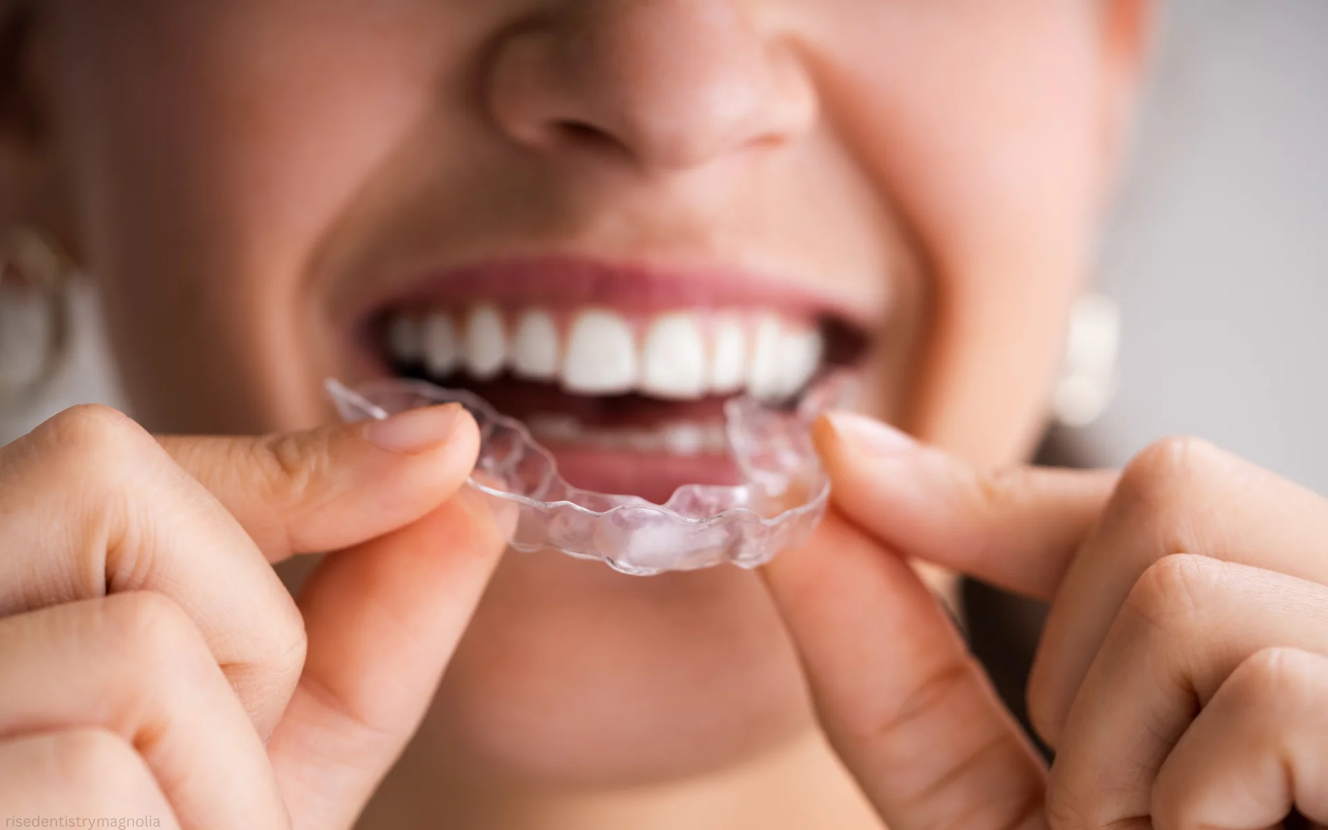 how do clear aligners work