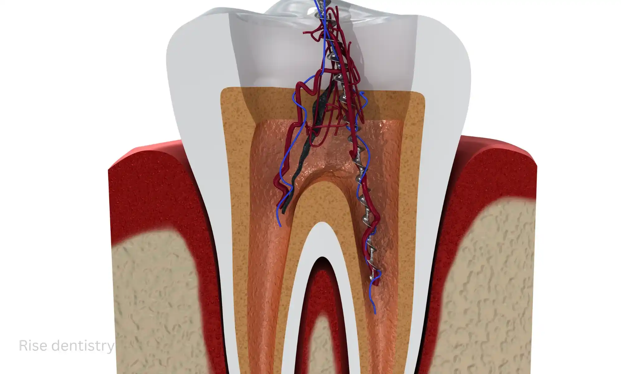 how long do root canals take