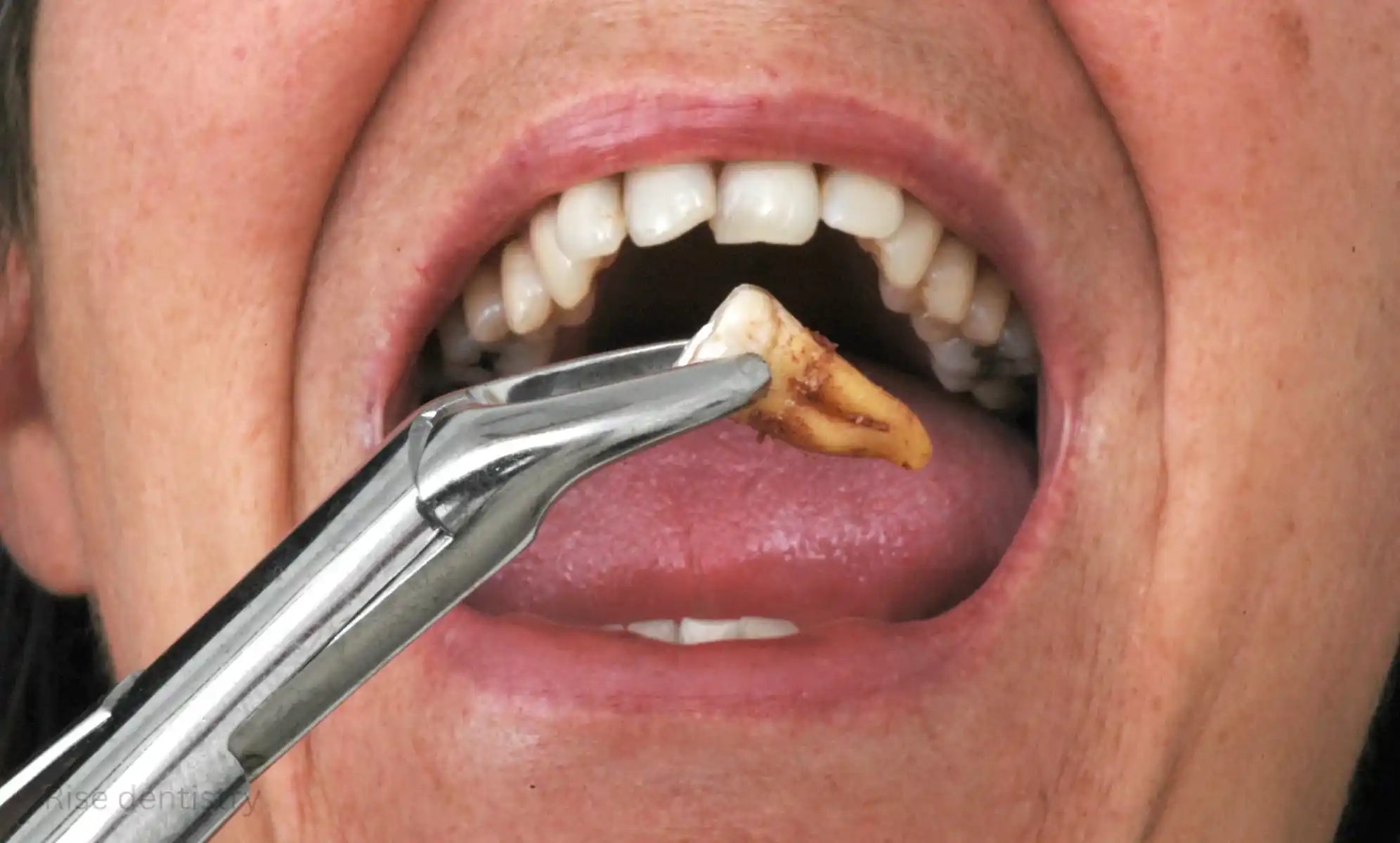 how long does a tooth extraction take