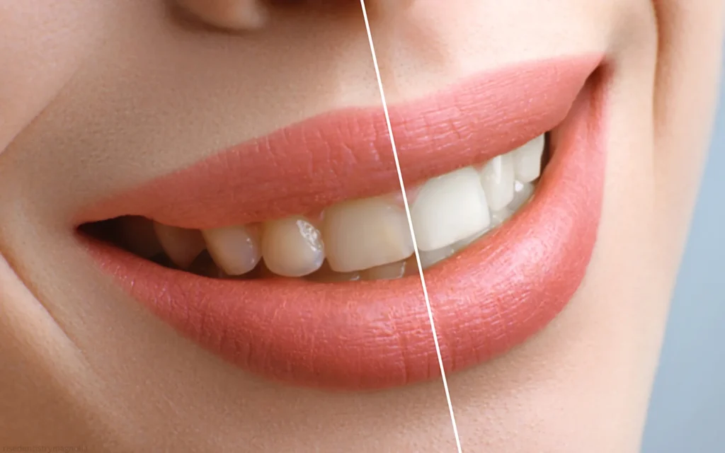 how long does teeth whitening last