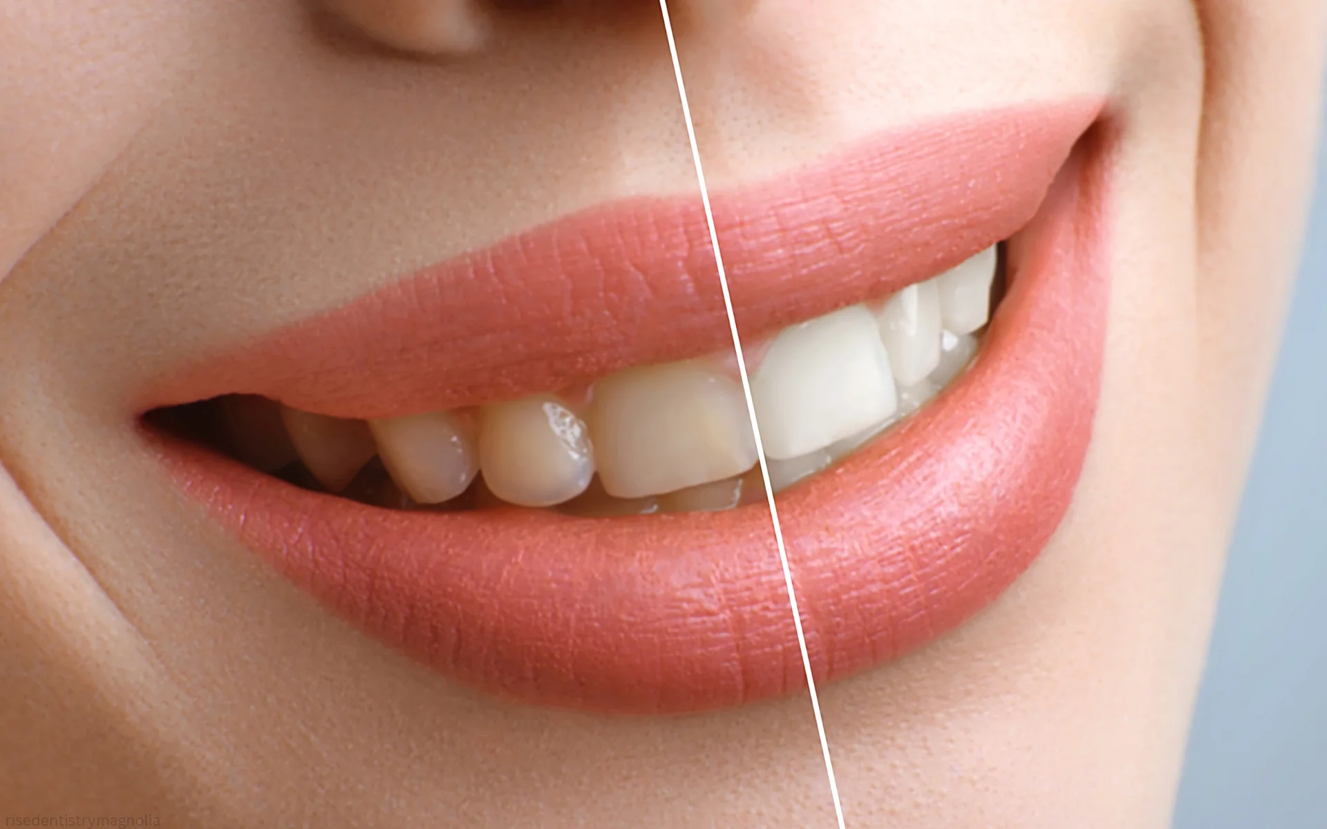 how long does teeth whitening last