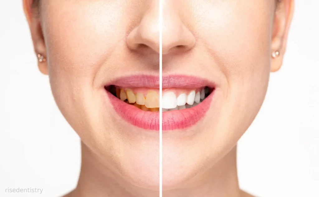 how much does teeth whitening price