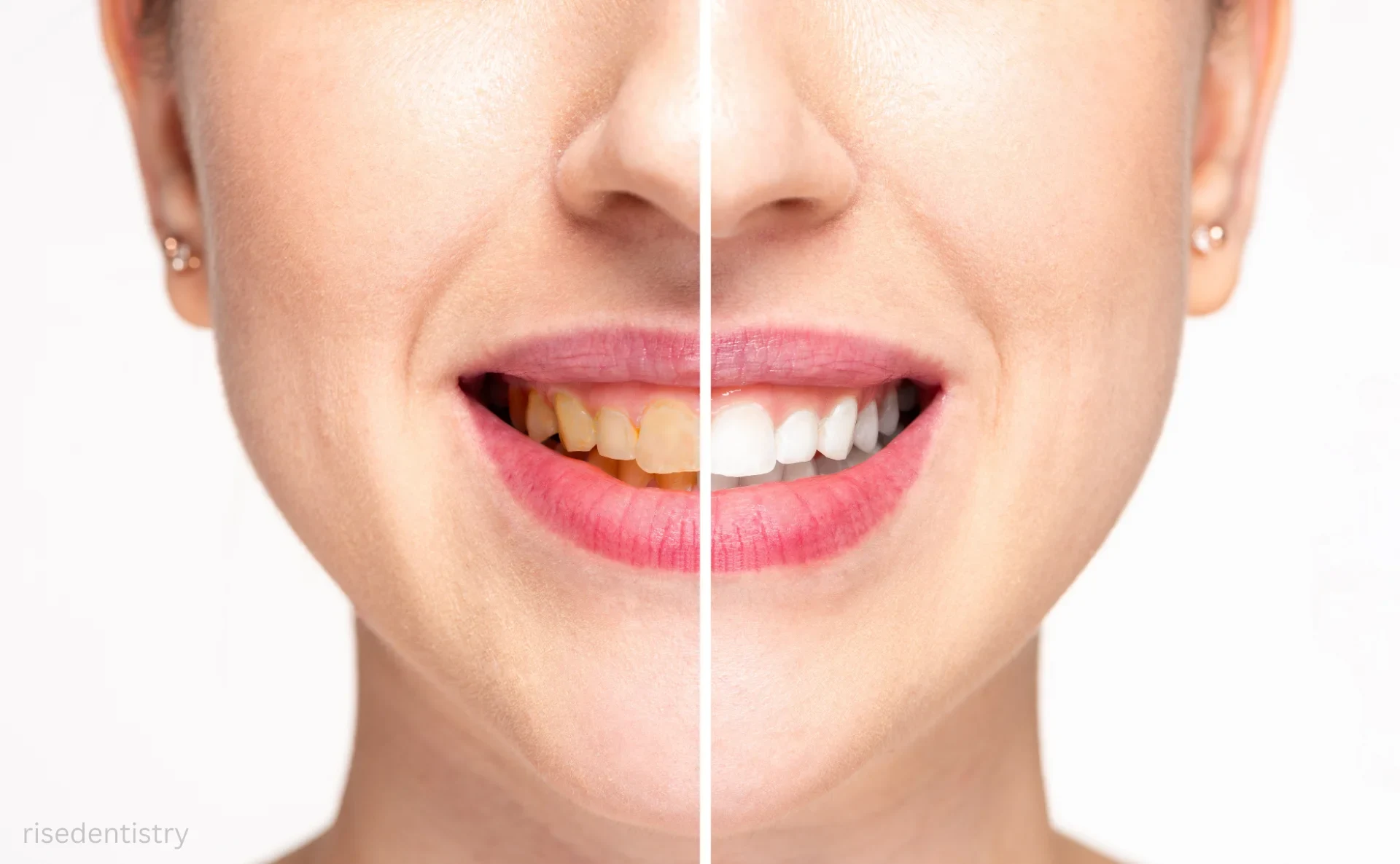 how much does teeth whitening price