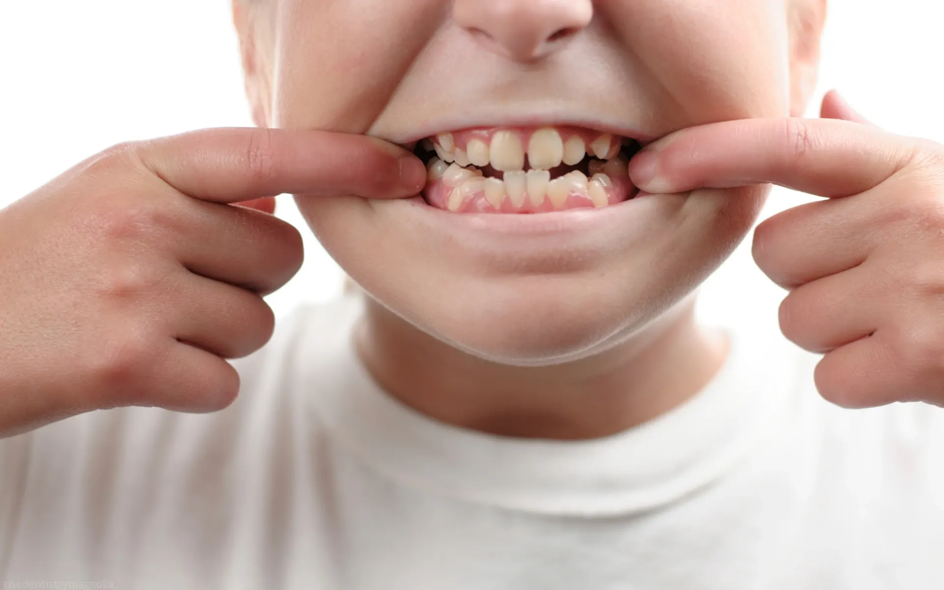 how to fix crooked teeth without braces