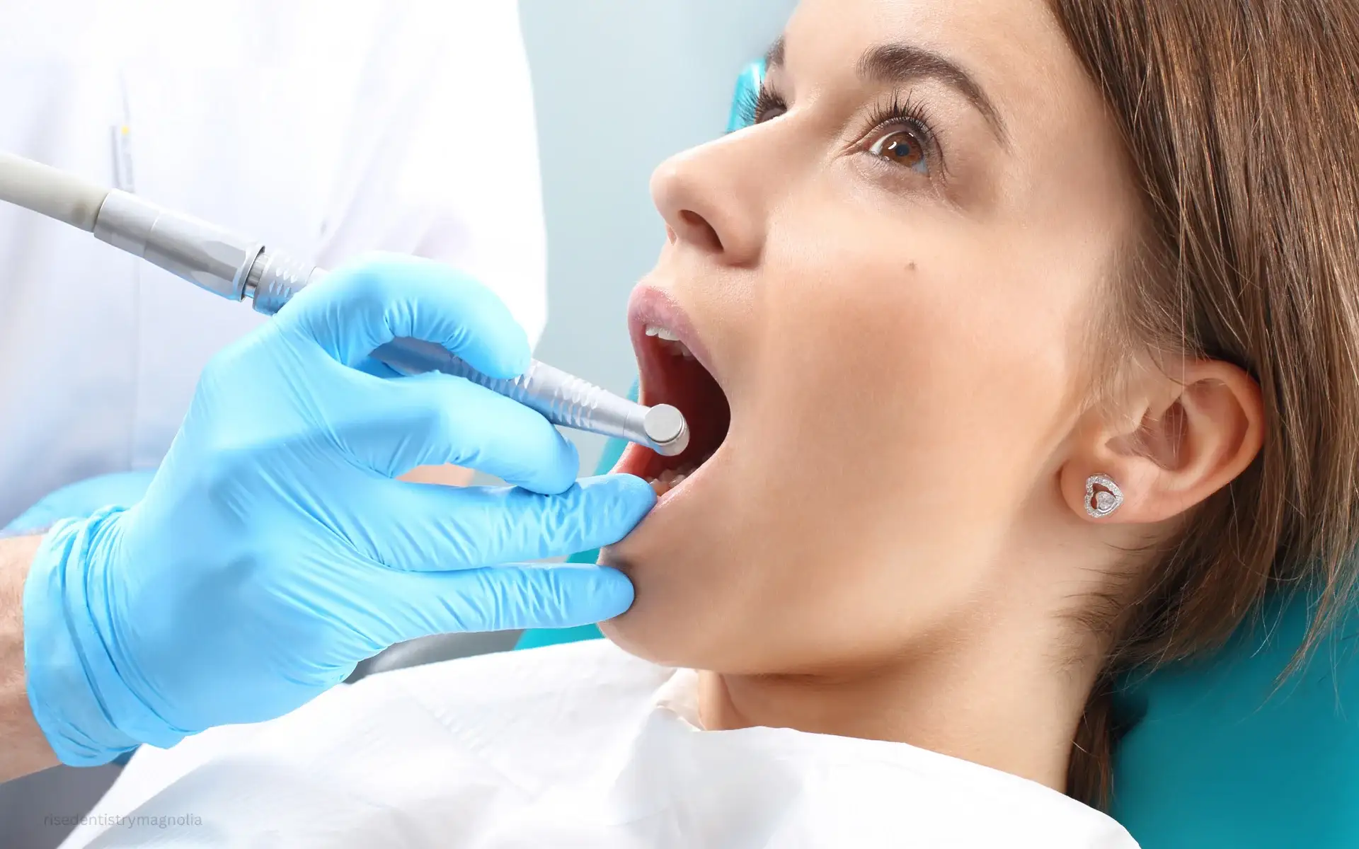 how to prepare for a root canal