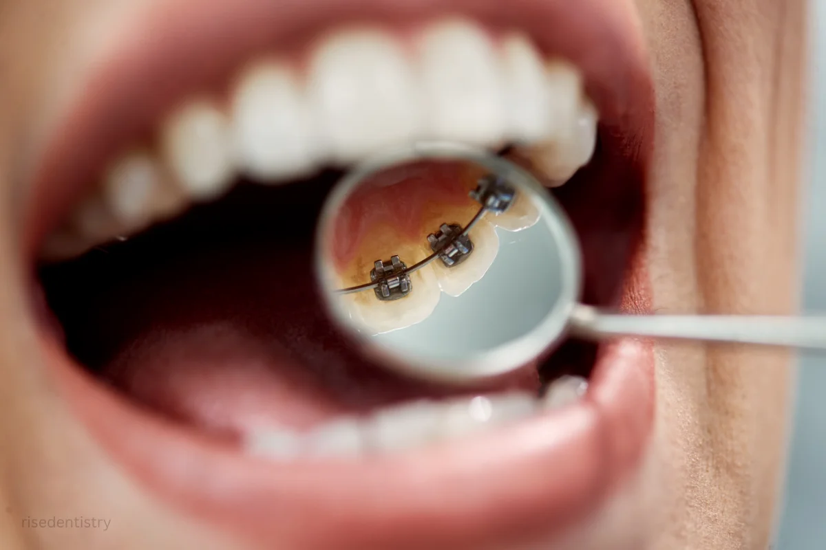options for straightening teeth