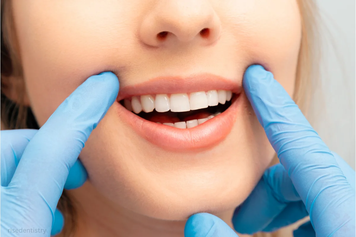 professional teeth whitening cost
