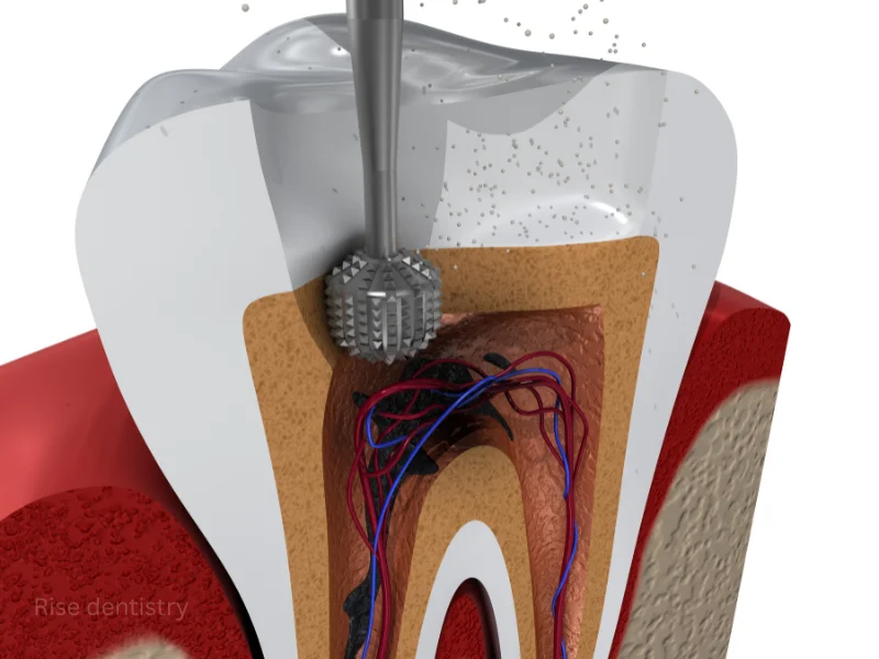 root canal treatment