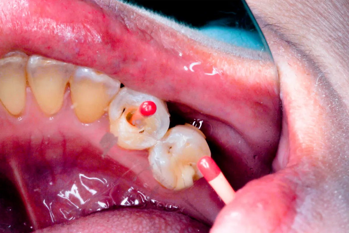 root canal vs extraction cost