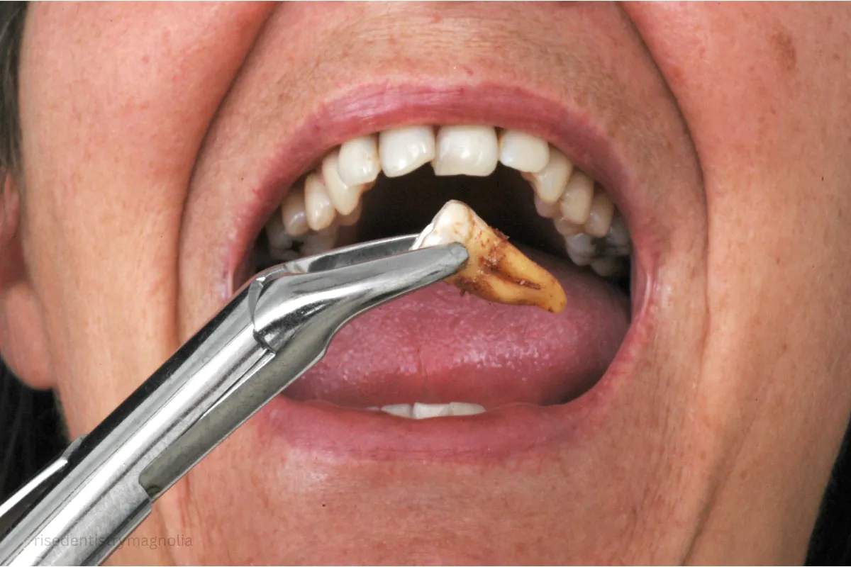root canal vs extraction