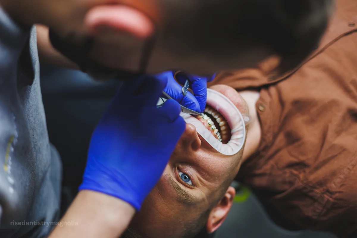 root canal vs filling cost