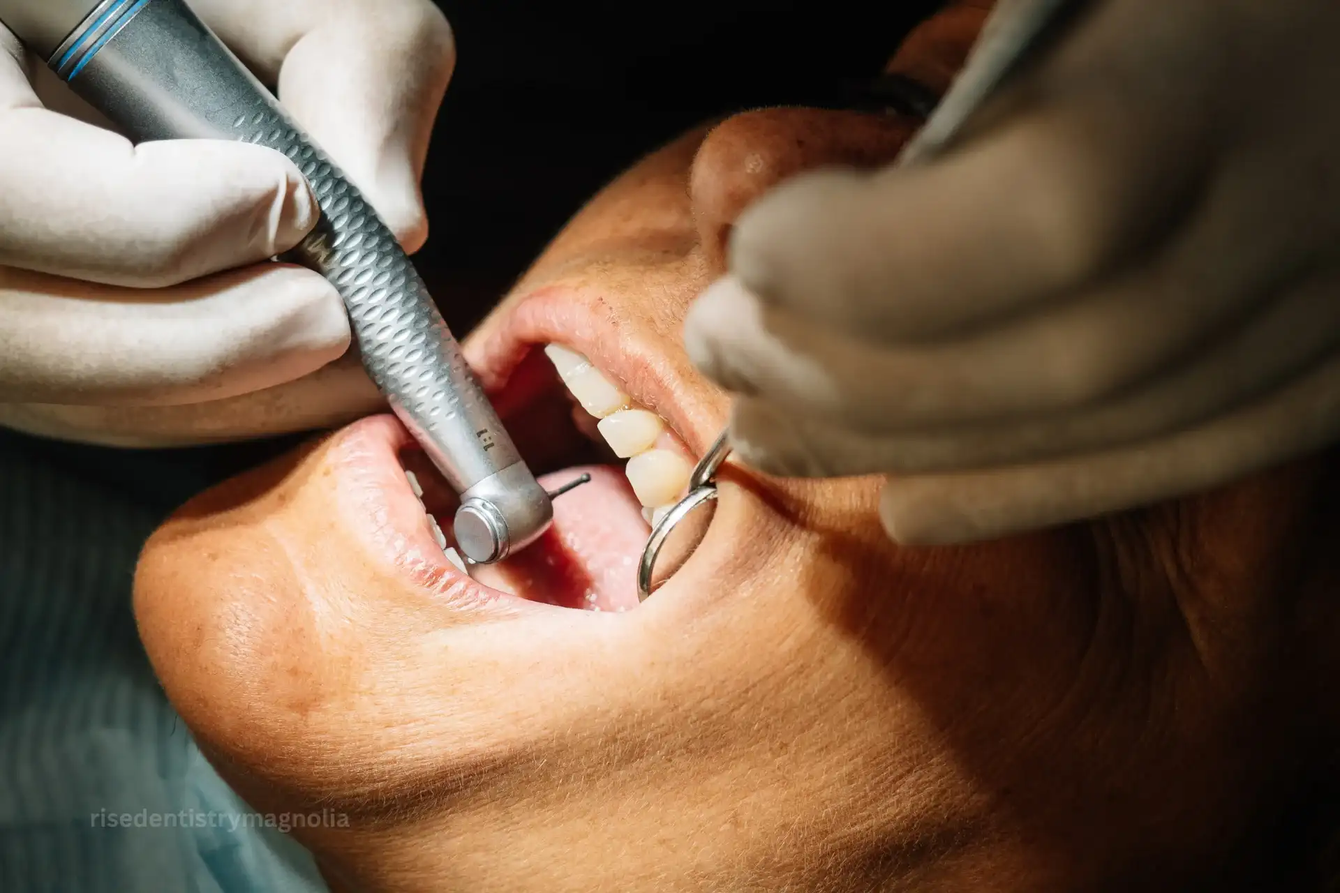 root canal vs filling