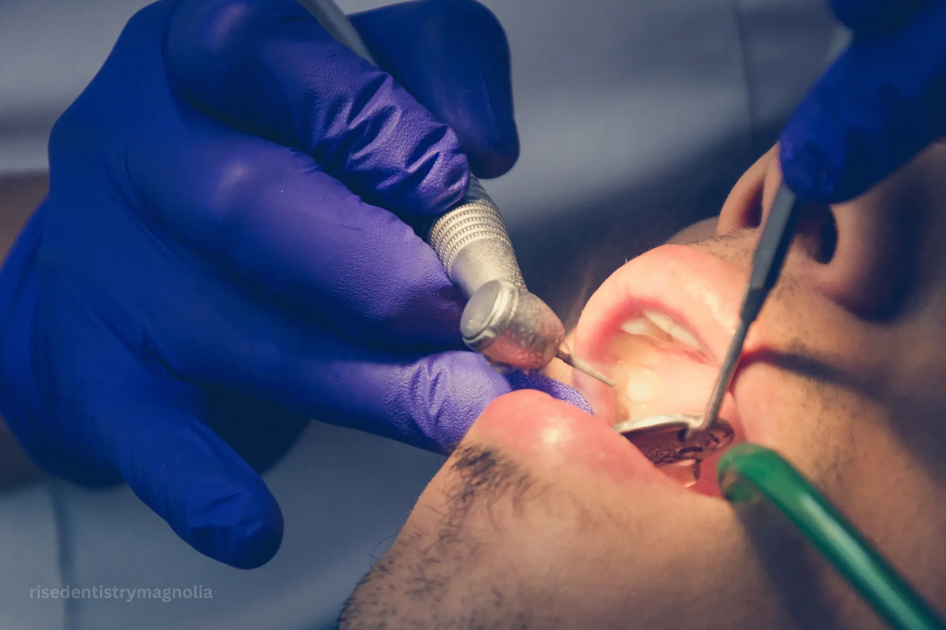 root canal vs implant