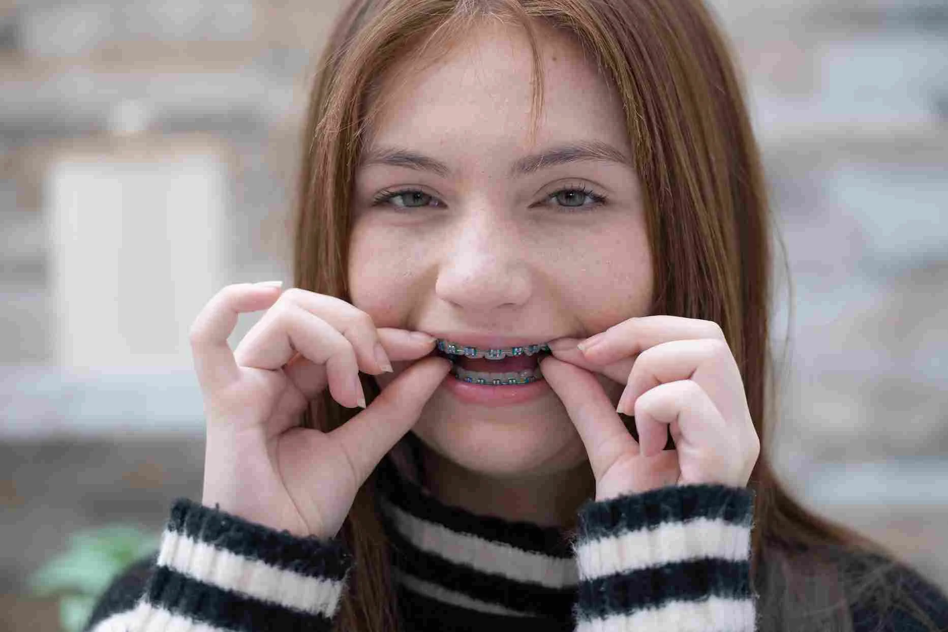 teenager aligners