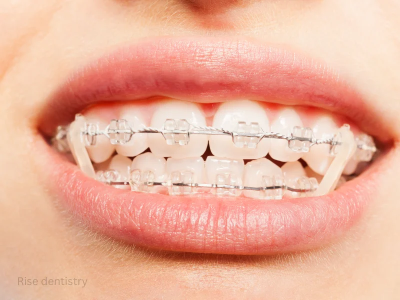 teeth alignment treatment for adults