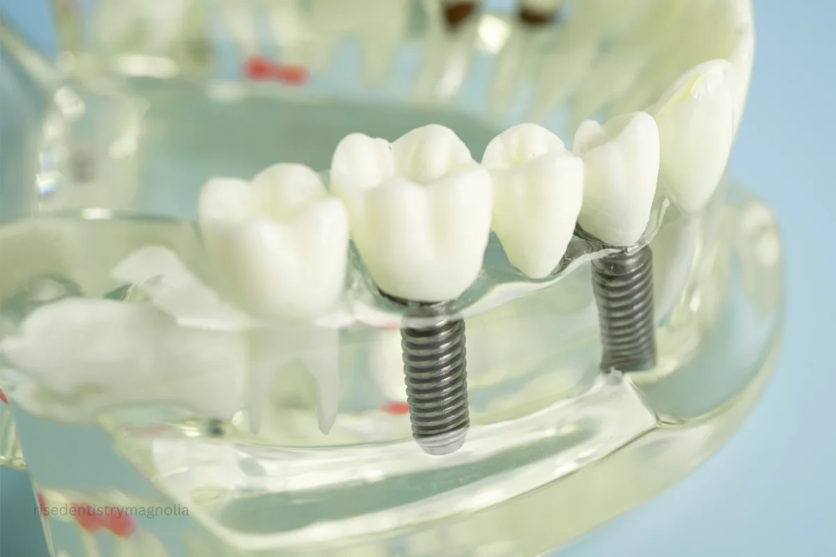 teeth root canal price