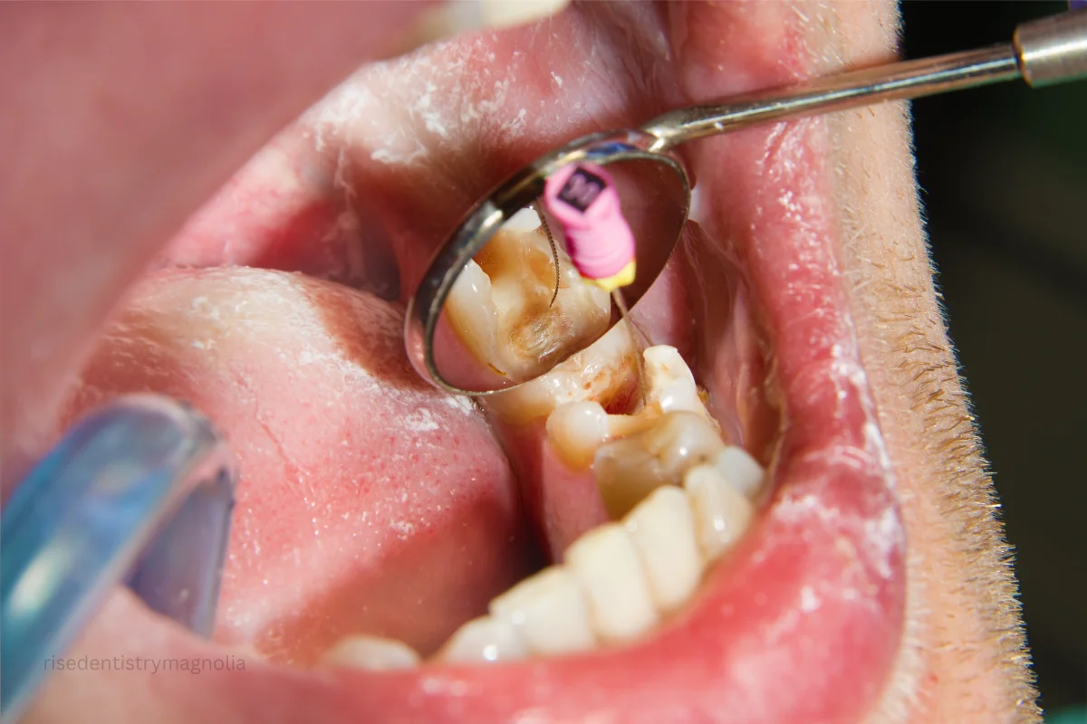 teeth root canal treatment cost