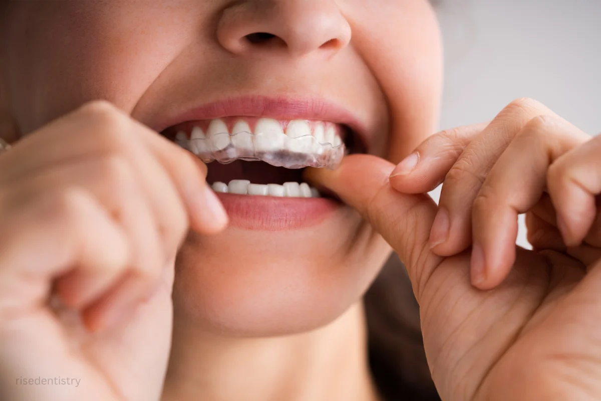 teeth straighten treatment timeline