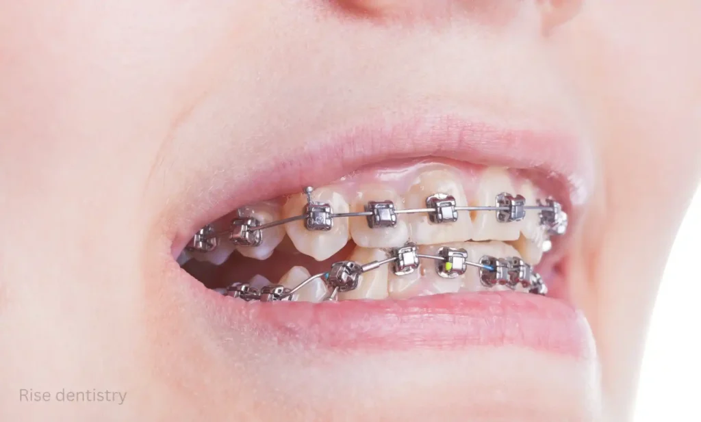 teeth straightening options for adults