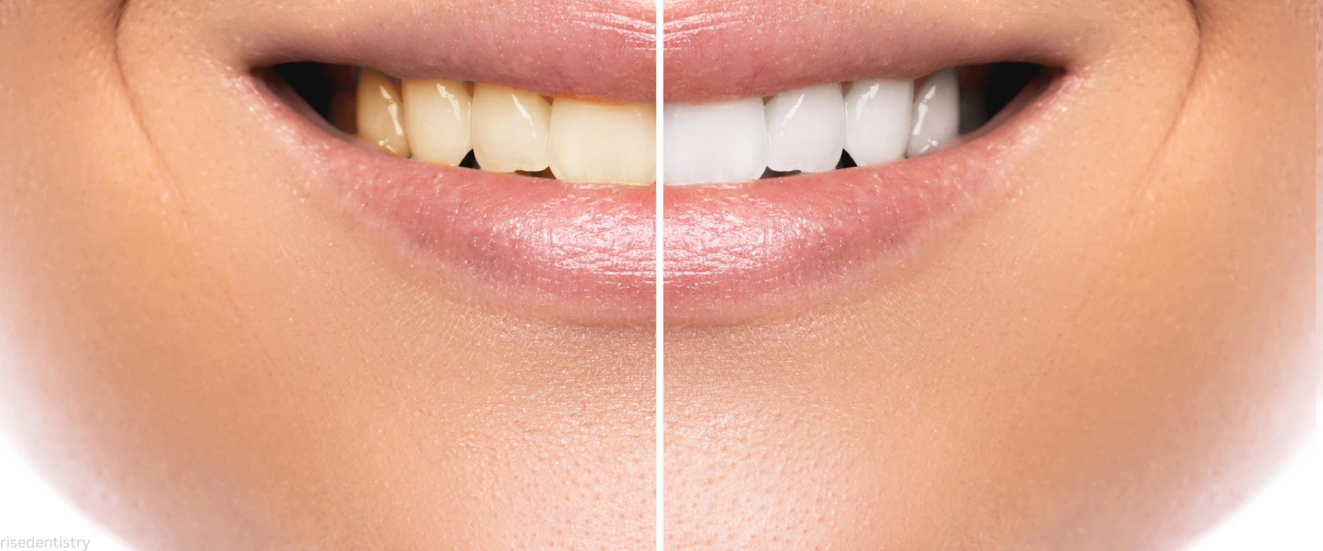 teeth whitening charges