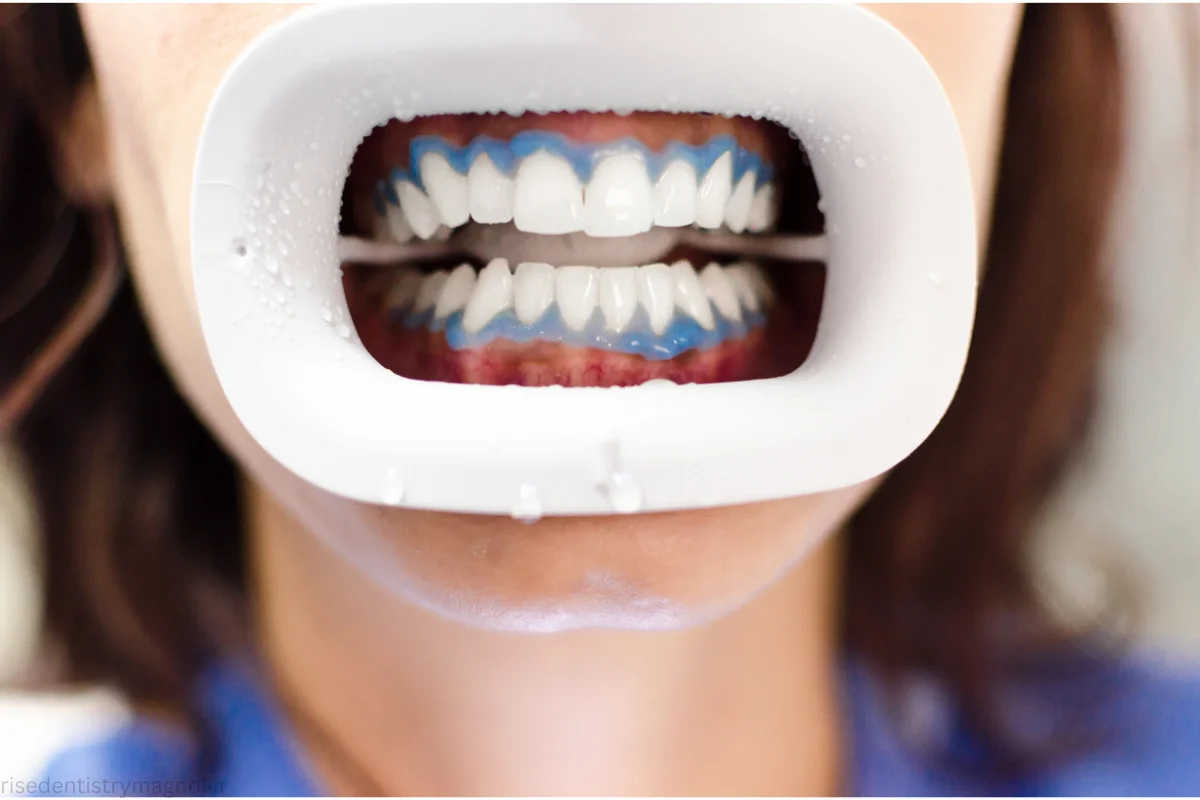 teeth whitening time