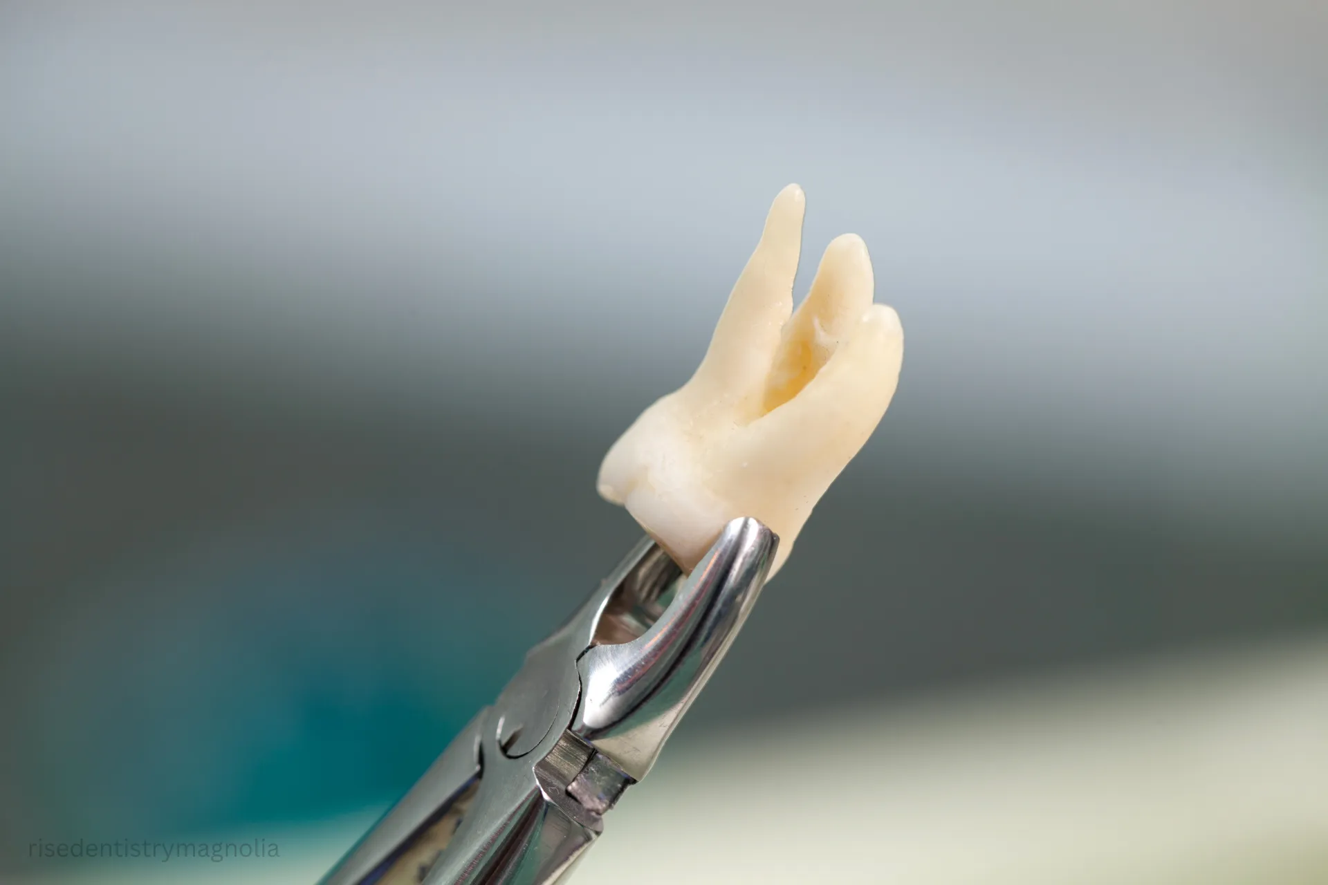 tooth extraction for braces