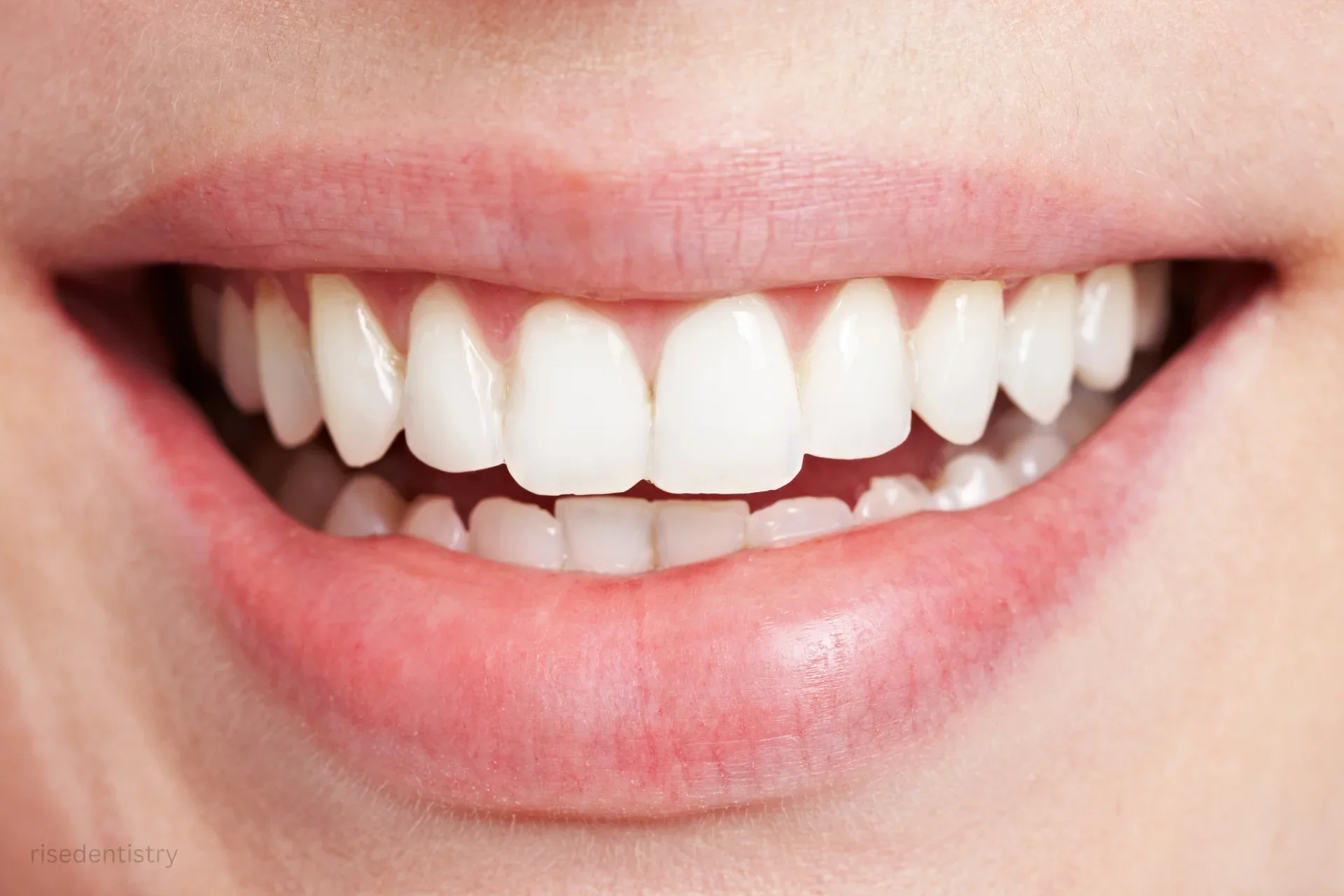 types of teeth straightening