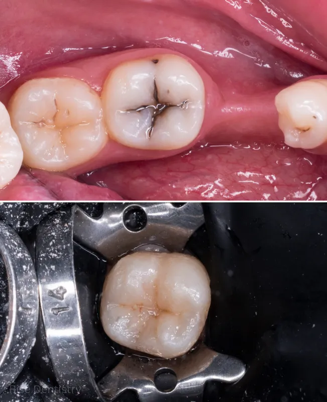 benefits of dental sealants