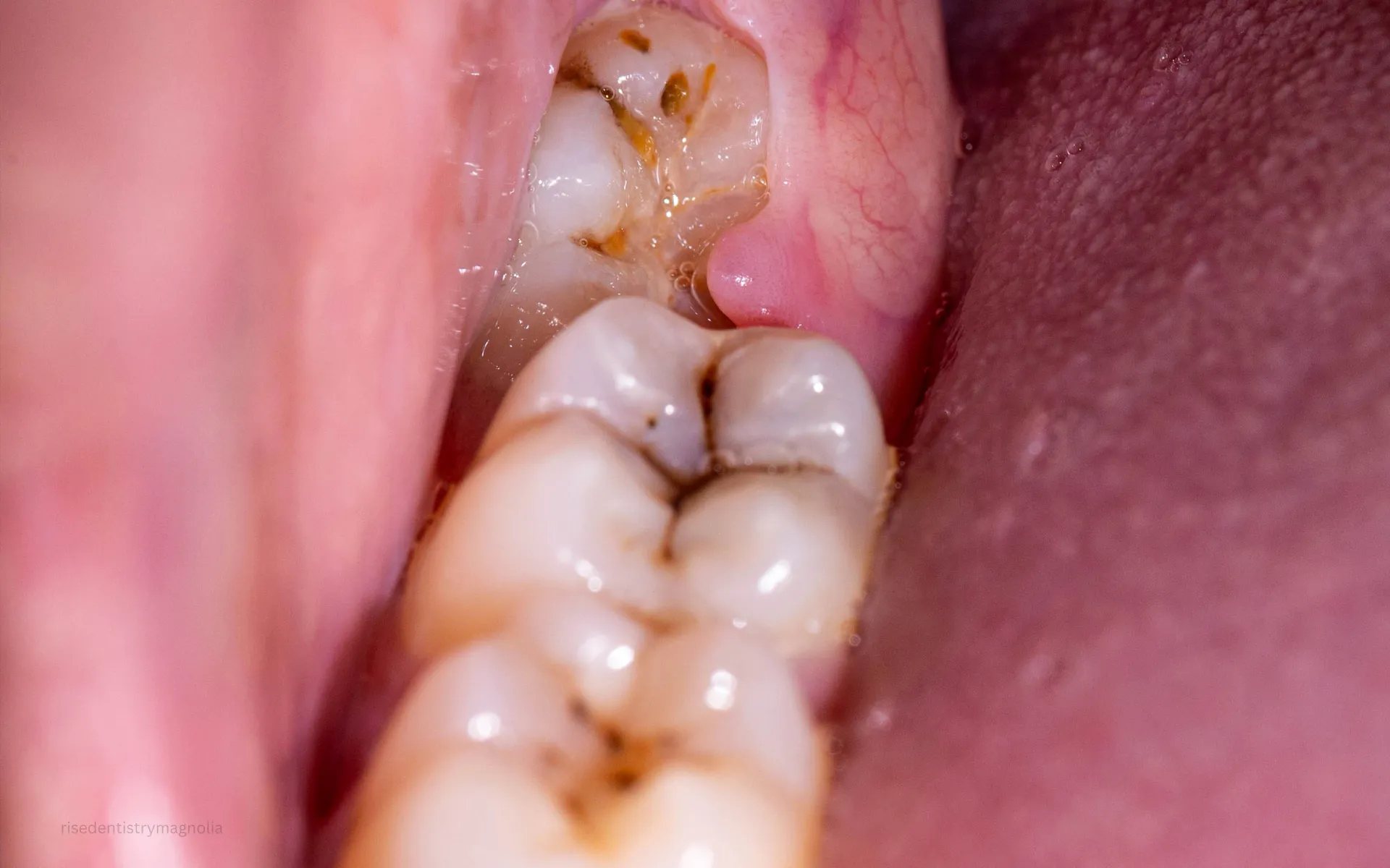 can wisdom teeth grow back