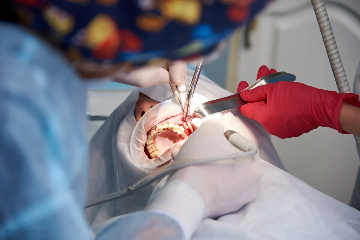 choosing between pulpotomy vs root canal
