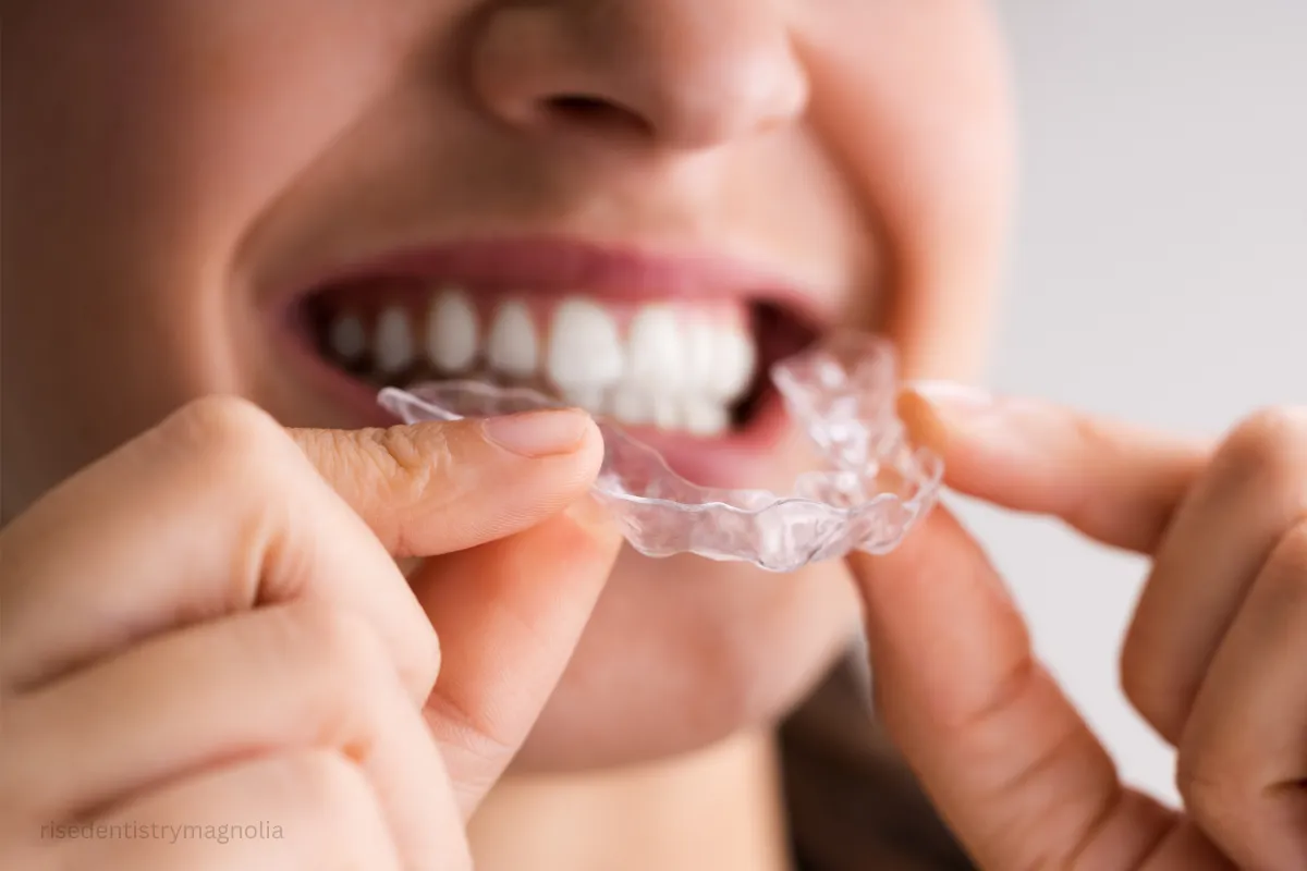 clear aligners for overbite