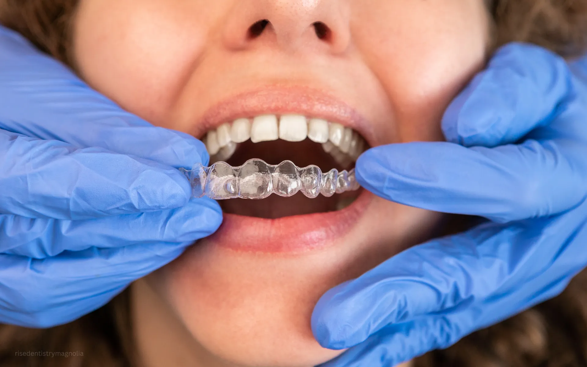 costs of clear aligners for overbite correction