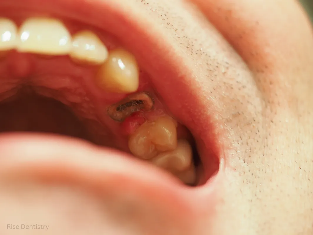 crowns and root canal