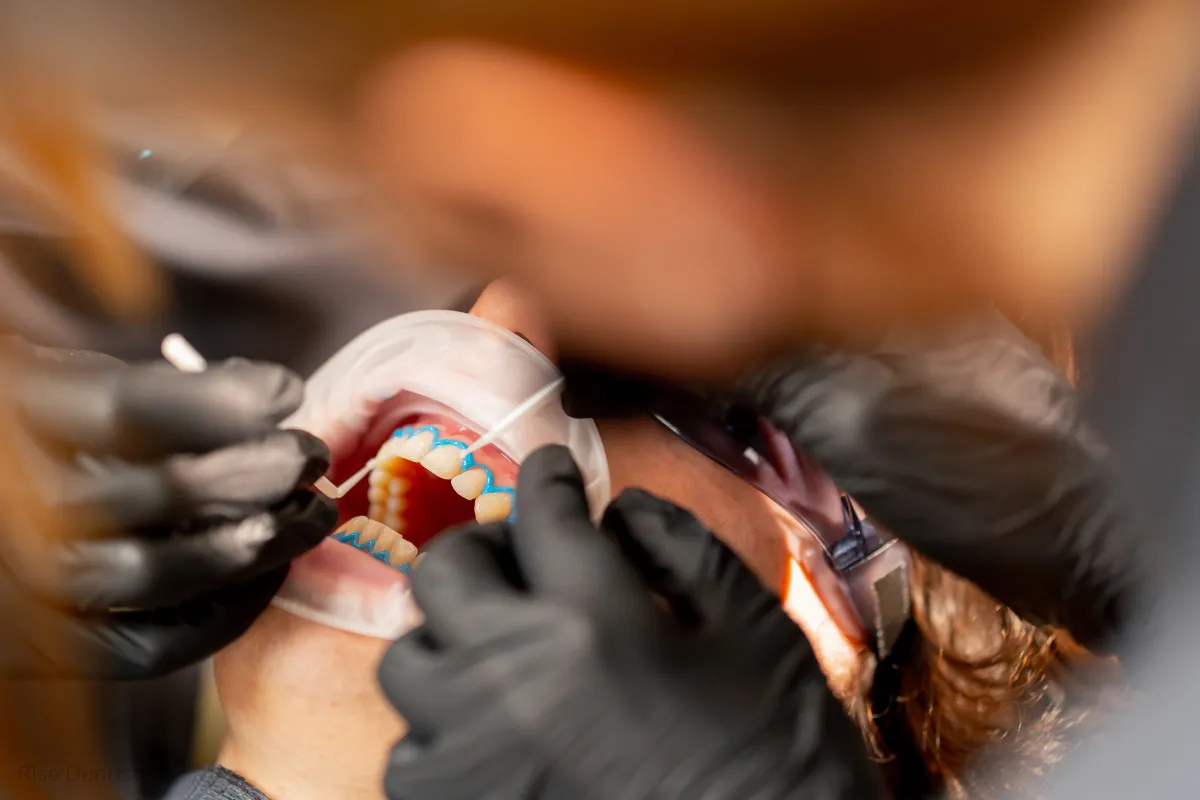 dental bonding results