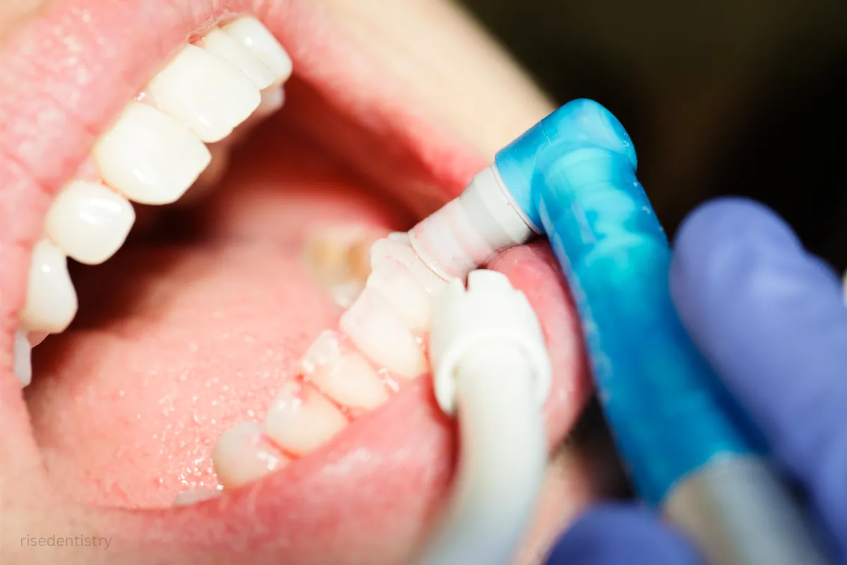 dental bonding vs. dental veneers