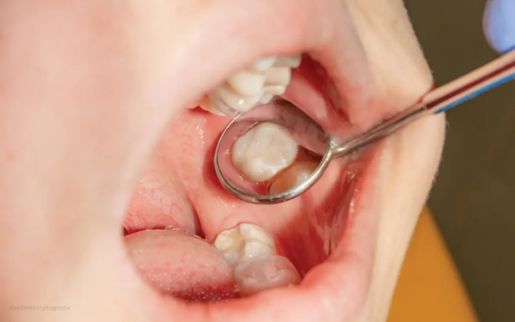 do root canals hurt