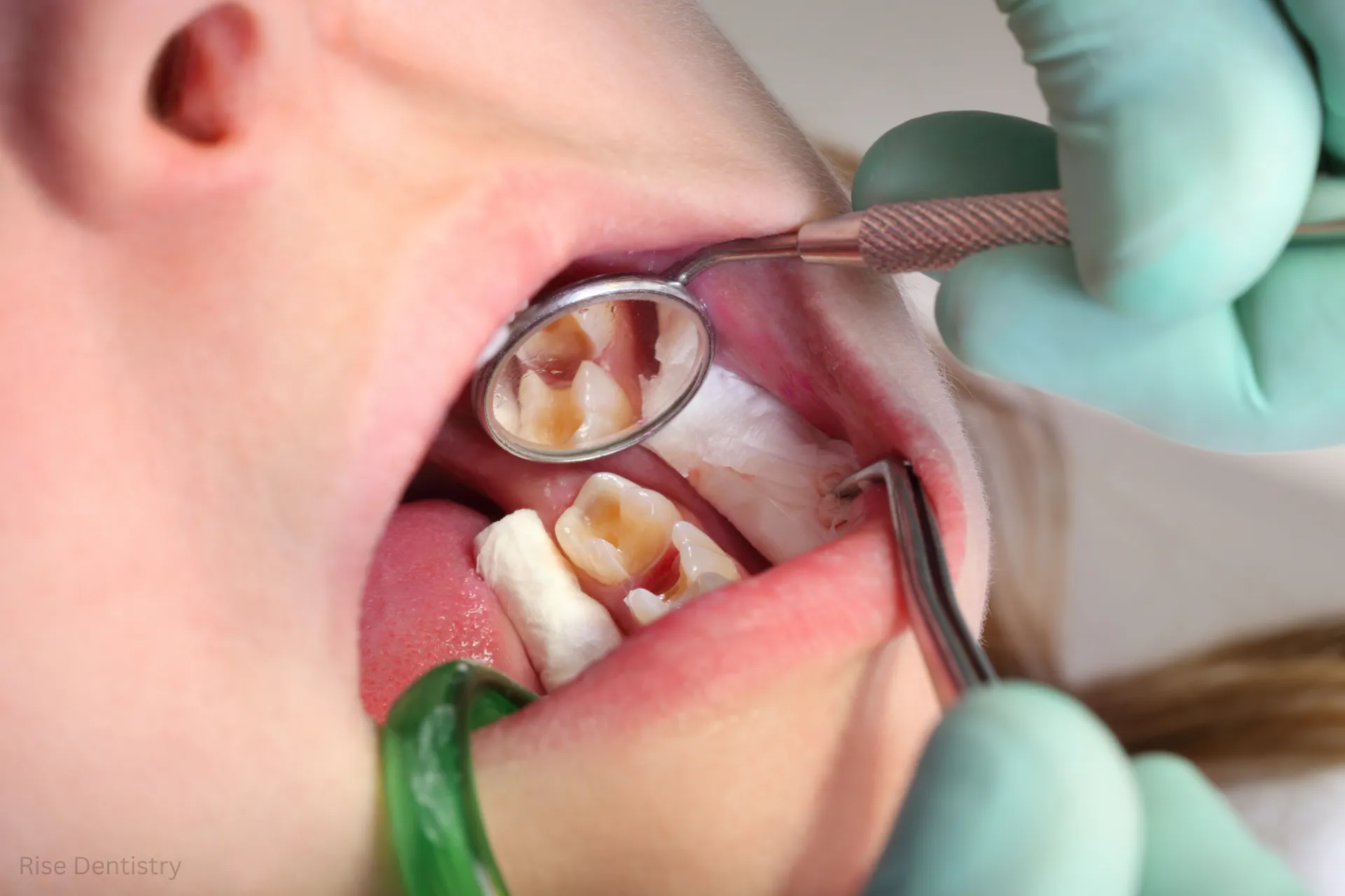 how long do dental sealants last